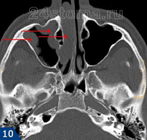 Полип в гайморовой пазухе. Полипозный хронический синусит на кт. Верхнечелюстной синусит кт. Хронический полипозный гайморит кт. Хронический полипозный риносинусит кт.