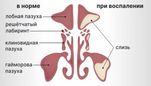 Как лечится острый синусит. Формы синусита 08 Как лечится острый синусит. Формы синусита 08