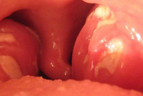 Ангина в первом триместре беременности. Ангина при беременности —, что делать, как лечить на ранних и поздних сроках, последствия 02