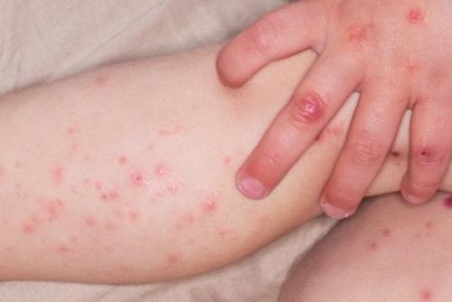 Коксаки у взрослых симптомы. Вирус Коксаки – симптомы