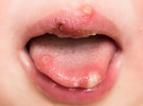 Коксаки у взрослых симптомы. Вирус Коксаки – симптомы