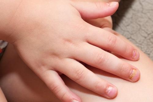 Коксаки у взрослых симптомы. Вирус Коксаки – симптомы