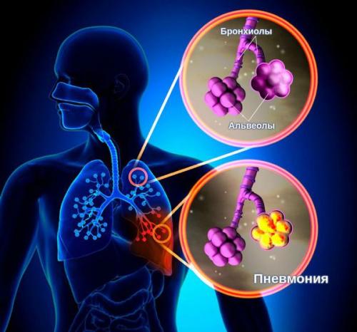 Как лечить аденовирусную инфекцию у взрослых. Симптомы аденовирусной инфекции 01