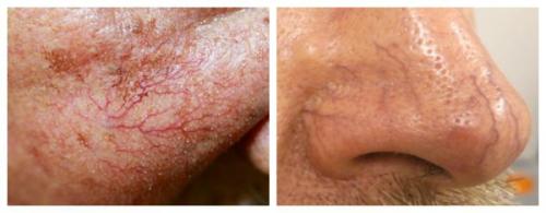 Как убрать покраснение носа после насморка. Симптомы экземы преддверия носа 03 Как убрать покраснение носа после насморка. Симптомы экземы преддверия носа 03