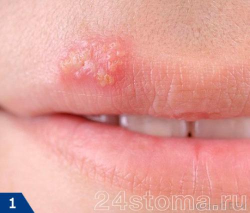 Герпес на лице лечение форум. Герпес: фото