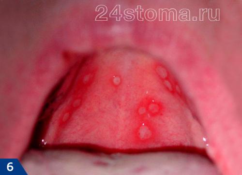 Герпес на лице лечение форум. Герпес: фото